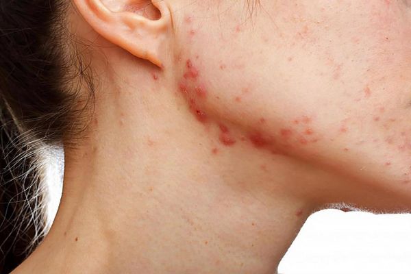 Làm thế nào để điều trị mụn trứng cá tuổi dậy thì đúng cách?