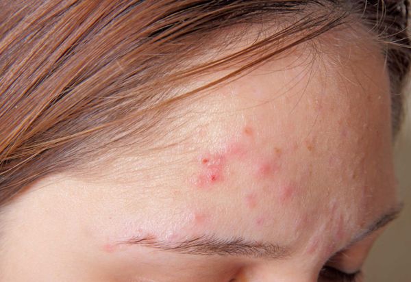 Làm thế nào để điều trị mụn trứng cá tuổi dậy thì đúng cách?