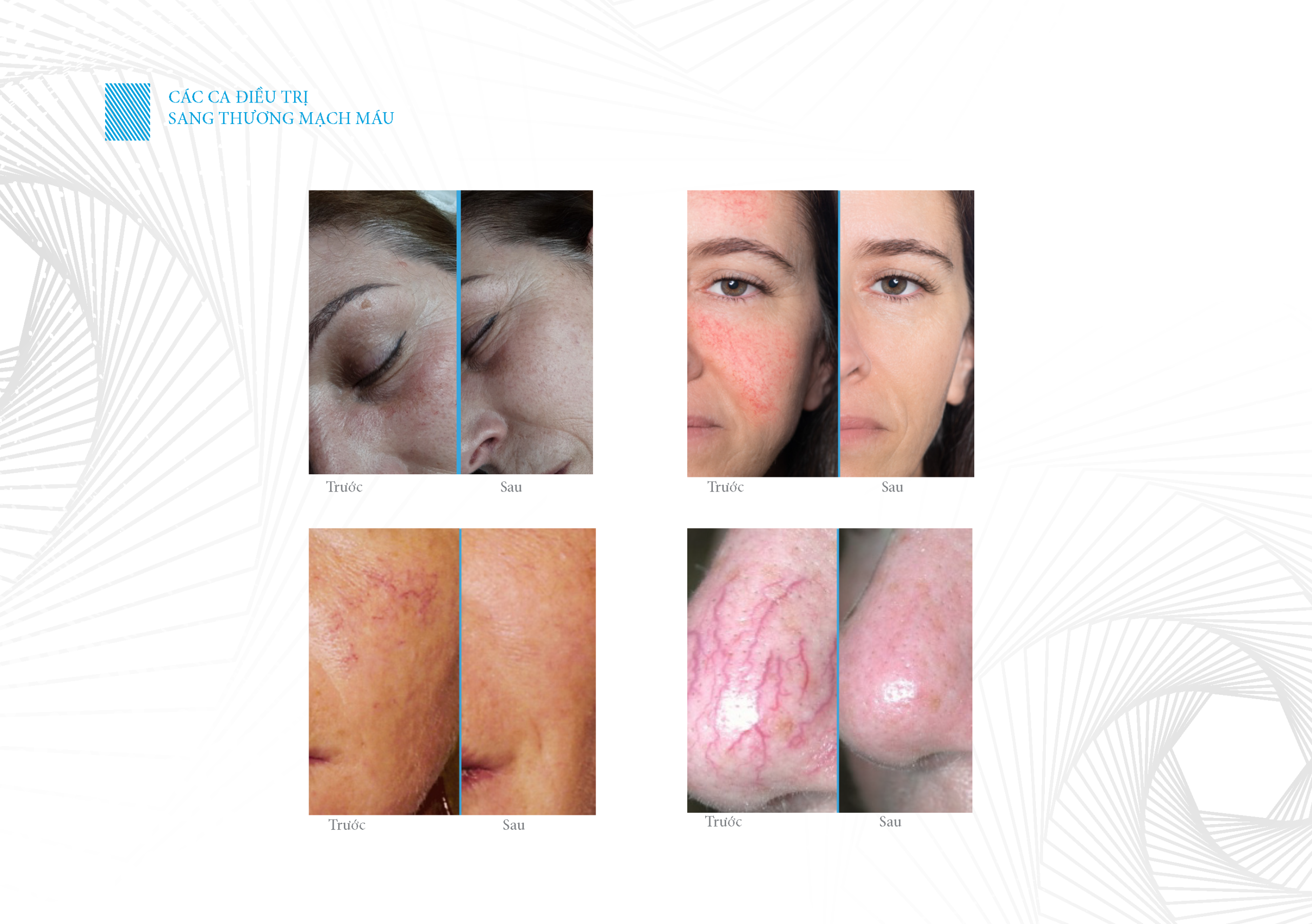 Xóa mạch máu, nốt ruồi son 7 Catalogue may blauman new Page 07 scaled