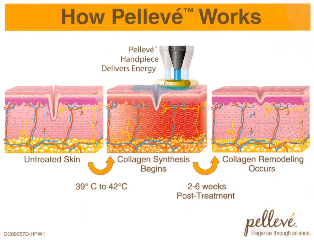 how pelleve works